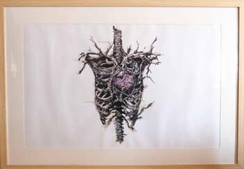 Artrhodèse des coeurs by Julie Balsaux