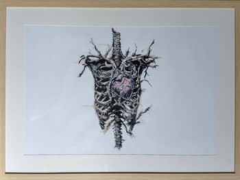 Artrhodèse des coeurs by Julie Balsaux