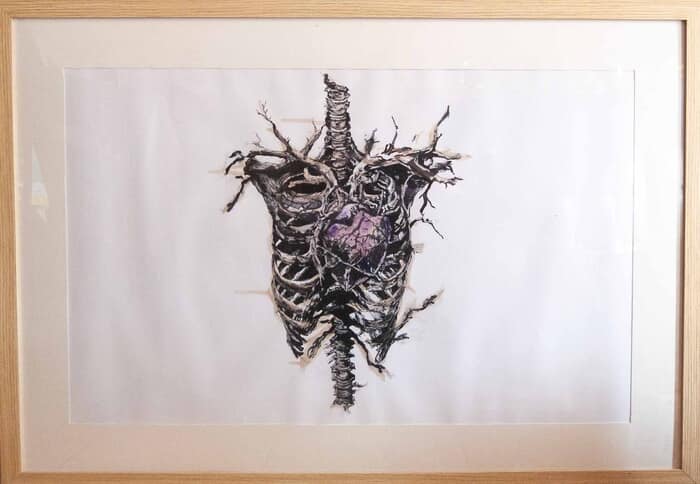 Artrhodèse des coeurs by Julie Balsaux